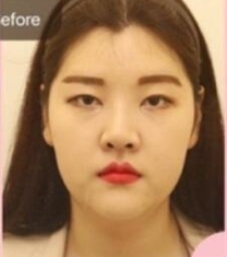 韩国mind整形外科-韩国MIND李康祐眼鼻轮廓整形前后照片