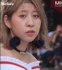 韩国MIGO整形医院眼鼻轮廓整形前后对比照片