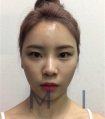 韩国mind曼德眼部整形+面部填充前后照片