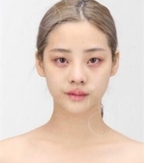 MIGO整形外科-韩国MIGO整形外科颧骨内推+自体脂肪面部填充前后照片