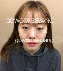 韩国高恩世上整形外科-韩国德丽珍眼鼻综合整形案例对比