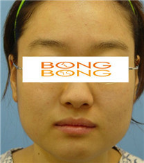 韩国棒棒整形外科面部轮廓整形案例图_术前