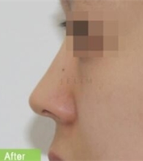韩国JELIM医院驼峰鼻矫正前后对比照片_术后