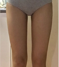 韩国丽妍k腿部吸脂案例对比图