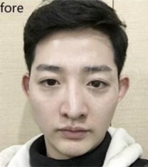 MIGO整形外科-韩国MIGO医院歪鼻矫正前后对比照片