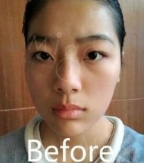 韩国MIGO医院眼鼻综合整形前后照片