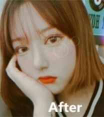 韩国MIGO眼鼻+面部吸脂整形前后对比照片