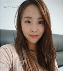 韩国丽妍k超声刀面部提升真人案例对比