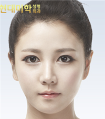 韩国现代美学整形医院-韩国现代美学小鹿眼整形案例恢复前后对比