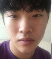 韩国GK男士眼鼻综合整形案例对比