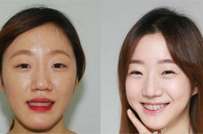 韩国做轮廓的医生排名，齐娥和英格金明镇算好吗？