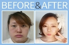 韩国灰姑娘整形医院面部轮廓手术效果如何？