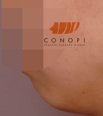 高诺鼻CONOPI整形外科-韩国高诺鼻下巴整形手术对比日记