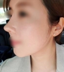 韩国丽丝塔金东奭小翘鼻整形前后对比照片_术后
