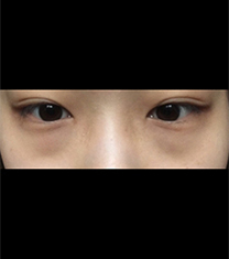 韩国新沙L整形外科黑眼圈手术真人案例对比