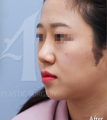韩国美自人鼻部整形对比案例
