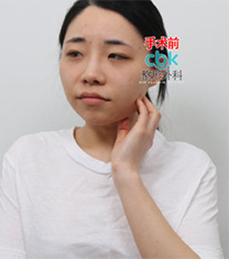 韩国CBK轮廓三件套+眼部整形真人案例照片