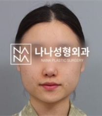 韩国NANA整形医院轮廓整形前后照片