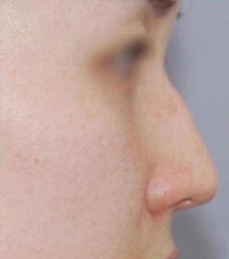 韩国娜娜NANA整形医院-韩国nana整形驼峰鼻矫正前后对比照片
