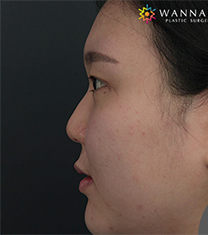 韩国奥纳比医院鼻部整形手术对比案例