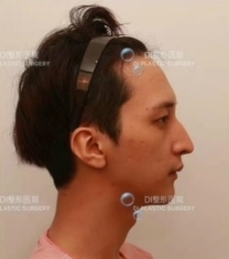 韩国DI李玟荣院长驼峰鼻矫正前后对比照片