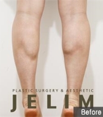韩国JELIM医院小腿退缩术前后对比照片