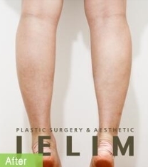 韩国JELIM医院小腿退缩术前后对比照片