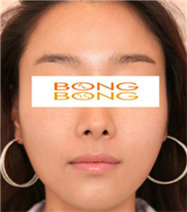 BONGBONG整形外科-韩国棒棒整形外科面部轮廓整形日记图