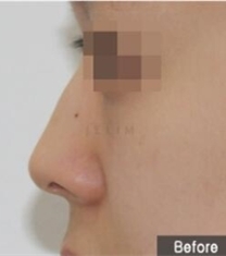 韩国JELIM医院驼峰鼻矫正前后对比照片