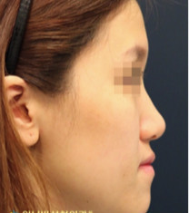 韩国奥纳比医院面部脂肪填充手术对比案例
