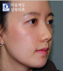 韩国首尔第一整形外科突嘴整形案例对比_术后