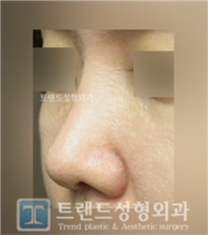 韩国trend整形外科蒜头鼻整形前后对比图_术后