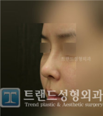 韩国trend整形医院-韩国trend整形外科朝天鼻修复对比案例