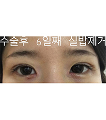 韩国SL双眼皮手术6天恢复案例前后_术后