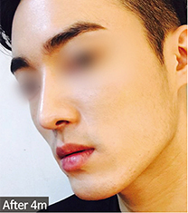 优尼克整形外科医院-韩国优尼克男士鼻整形真人案例对比