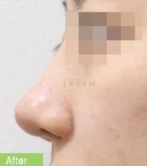 韩国jelim整形医院-韩国JELIM医院短鼻矫正前后对比照片