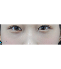 韩国新沙L整形外科-韩国新沙L祛黑眼圈整形真人前后对比