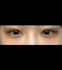 韩国新沙L整形外科黑眼圈手术真人日记对比