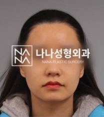 韩国娜娜NANA整形医院-韩国娜娜整形医院面部轮廓整形前后照片