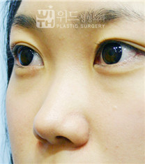 韩国维德整形外科隆鼻手术案例对比图