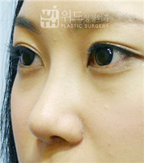 韩国维德整形外科隆鼻手术案例对比图_术后