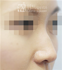 韩国维德驼峰鼻整形日记3个月恢复对比图