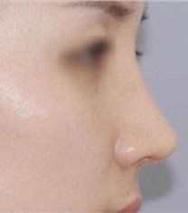 韩国娜娜NANA整形医院-韩国nana整形驼峰鼻矫正前后对比照片