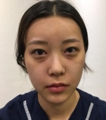 韩国Premiere-韩国普瑞美张裕珍面部填充+鼻部矫正前后照片