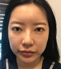 韩国Premiere-普瑞美张裕珍福鼻矫正前后对比照片