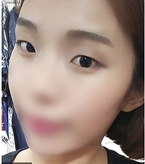韩国优尼克李世彬埋线双眼皮两周恢复照片