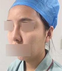 上海薇琳医美整形-上海薇琳鼻挛缩修复真人案例对比