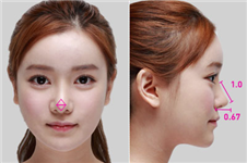 鼻头鼻翼缩小术在韩国已是普遍整形，价格在多少钱算正常
