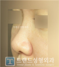 韩国trend整形外科蒜头鼻整形前后对比图