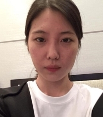 韩国美可整形李圣俊眼鼻面部填充前后对比照片